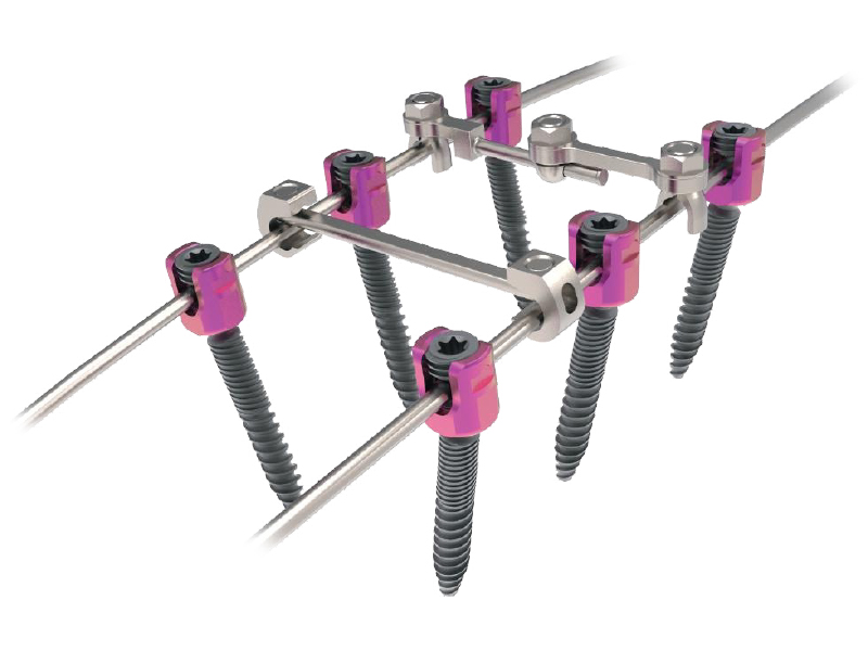 SPINAL SCREW SYSTEM – QUADLEAD DUAL THREADED SCREW